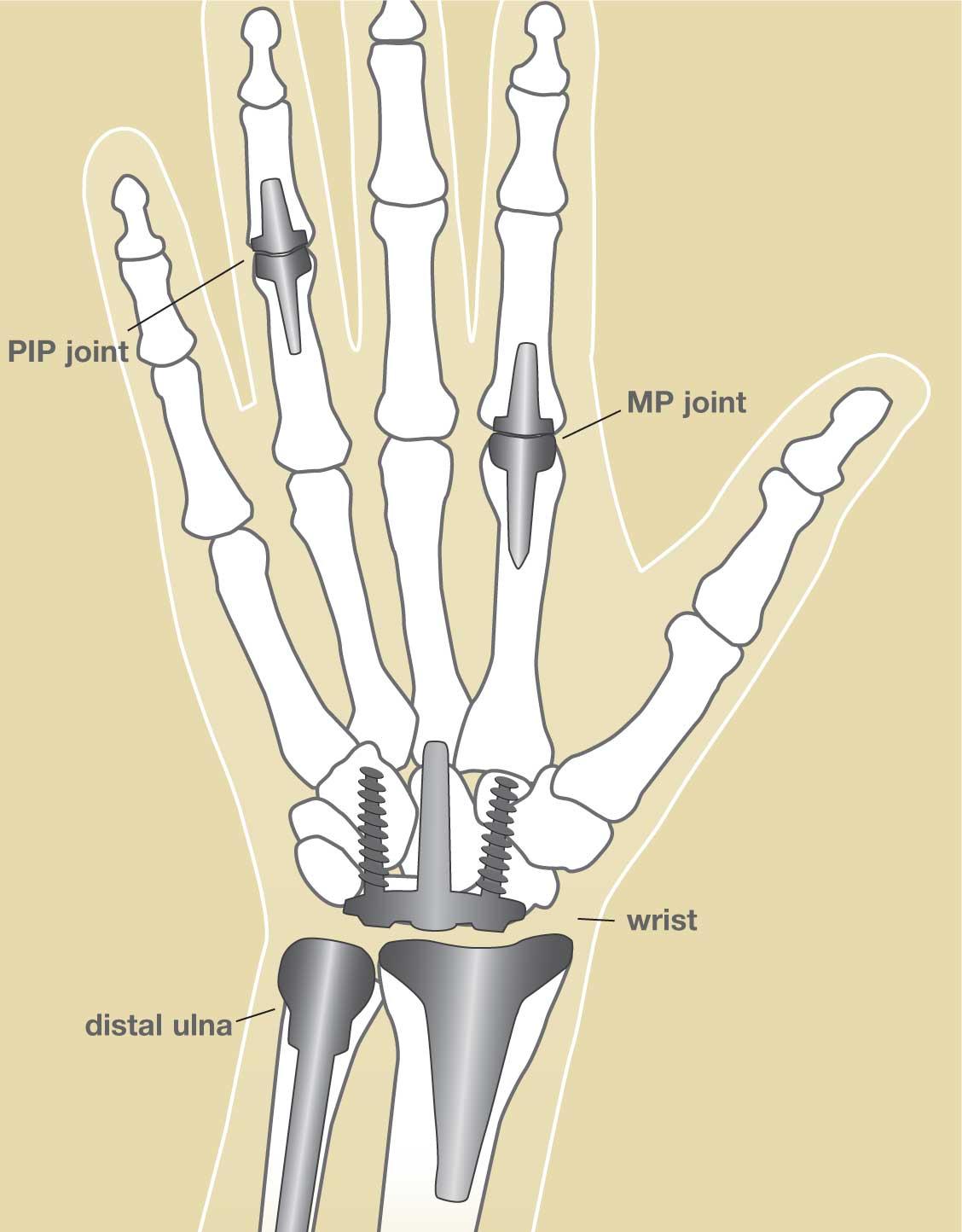 Wrist Joint Replacement